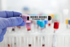Anemia autoimmunity