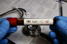 Cytomegalovirus test